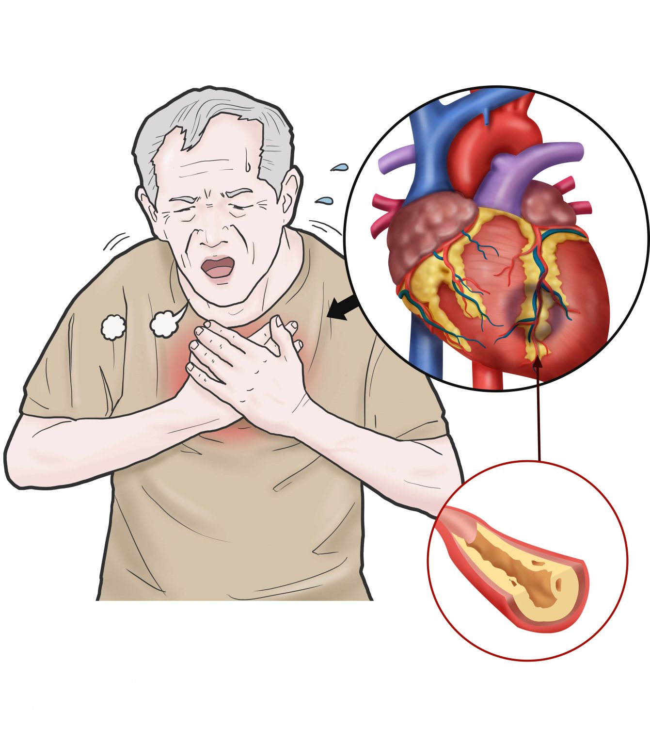 Angina pektoris ne kadar sürer?